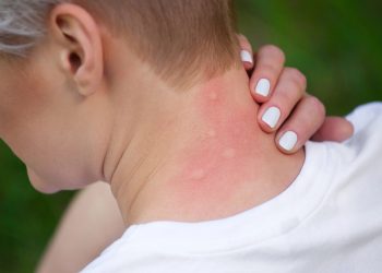 Mosquitos preferem certas pessoas (e cores): como evitar picadas dolorosas este verão