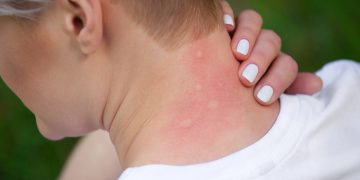 Mosquitos preferem certas pessoas (e cores): como evitar picadas dolorosas este verão