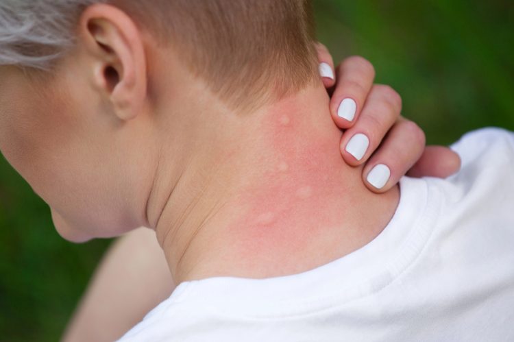 Mosquitos preferem certas pessoas (e cores): como evitar picadas dolorosas este verão