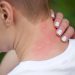 Mosquitos preferem certas pessoas (e cores): como evitar picadas dolorosas este verão
